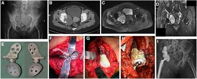 Clinical outcomes in patients with neurological disorders following periacetabular tumor removal and endoprosthetic reconstruction of the hemipelvis